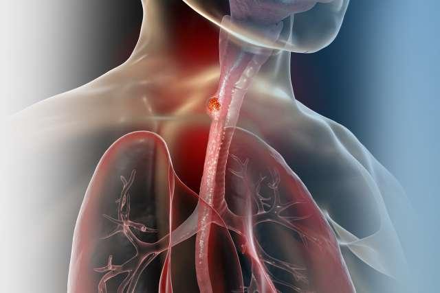 食管癌，三维图像显示人类食道恶性肿瘤